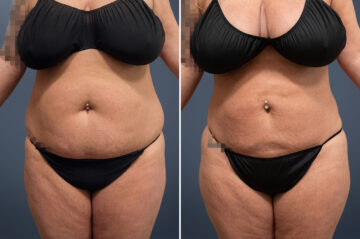 Liposuction Before and After Photos in Princeton, NJ, Patient 23215