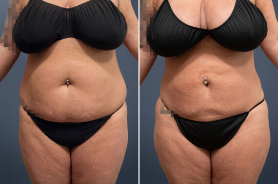 Liposuction Before and After Photos in Princeton, NJ, Patient 23215