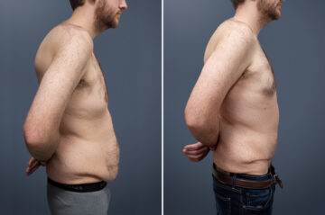 Tummy Tuck Before and After Photos in Princeton, NJ, Patient 23221