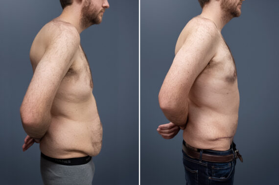 Tummy Tuck Before and After Photos in Princeton, NJ, Patient 23221