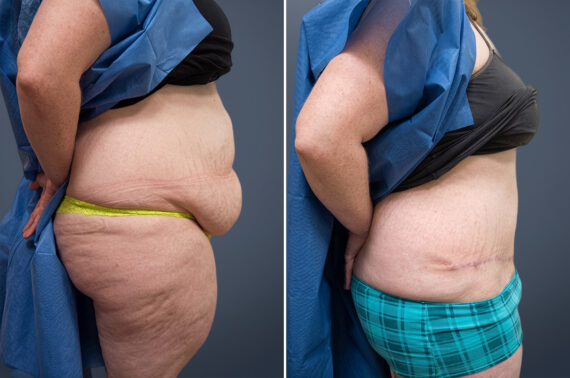 Tummy Tuck Before and After Photos in Princeton, NJ, Patient 23228