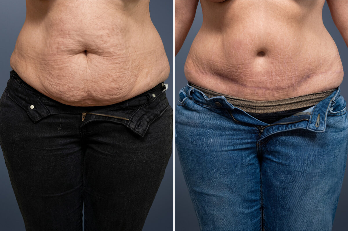 Tummy Tuck Before and After Photos in Princeton, NJ, Patient 23232