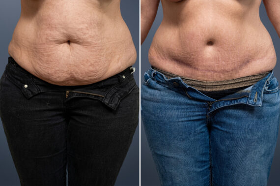 Tummy Tuck Before and After Photos in Princeton, NJ, Patient 23232