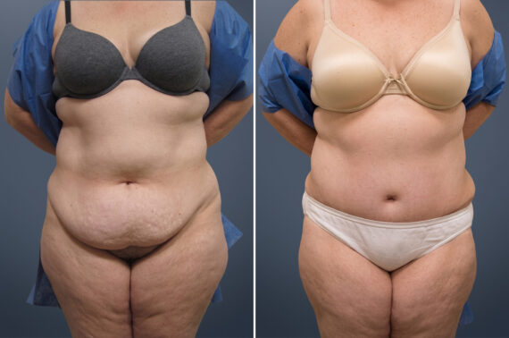 Tummy Tuck Before and After Photos in Princeton, NJ, Patient 23236