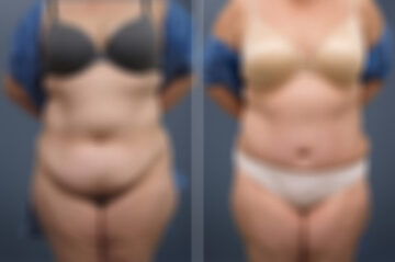 Tummy Tuck Before and After Photos in Princeton, NJ, Patient 23236