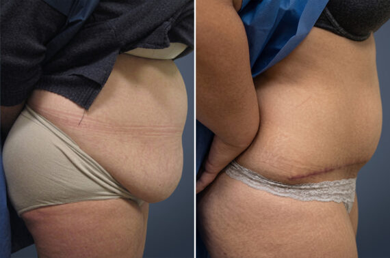 Tummy Tuck Before and After Photos in Princeton, NJ, Patient 23240