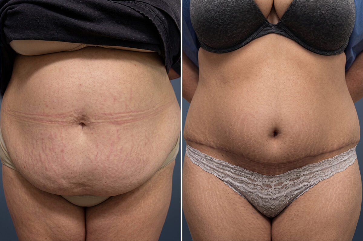 Tummy Tuck Before and After Photos in Princeton, NJ, Patient 23240