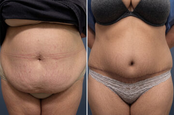Tummy Tuck Before and After Photos in Princeton, NJ, Patient 23240