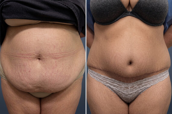 Tummy Tuck Before and After Photos in Princeton, NJ, Patient 23240