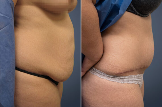 Tummy Tuck Before and After Photos in Princeton, NJ, Patient 23247
