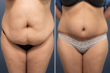 Tummy Tuck Before and After Photos in Princeton, NJ, Patient 23247
