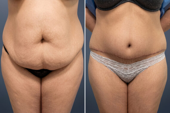 Tummy Tuck Before and After Photos in Princeton, NJ, Patient 23247