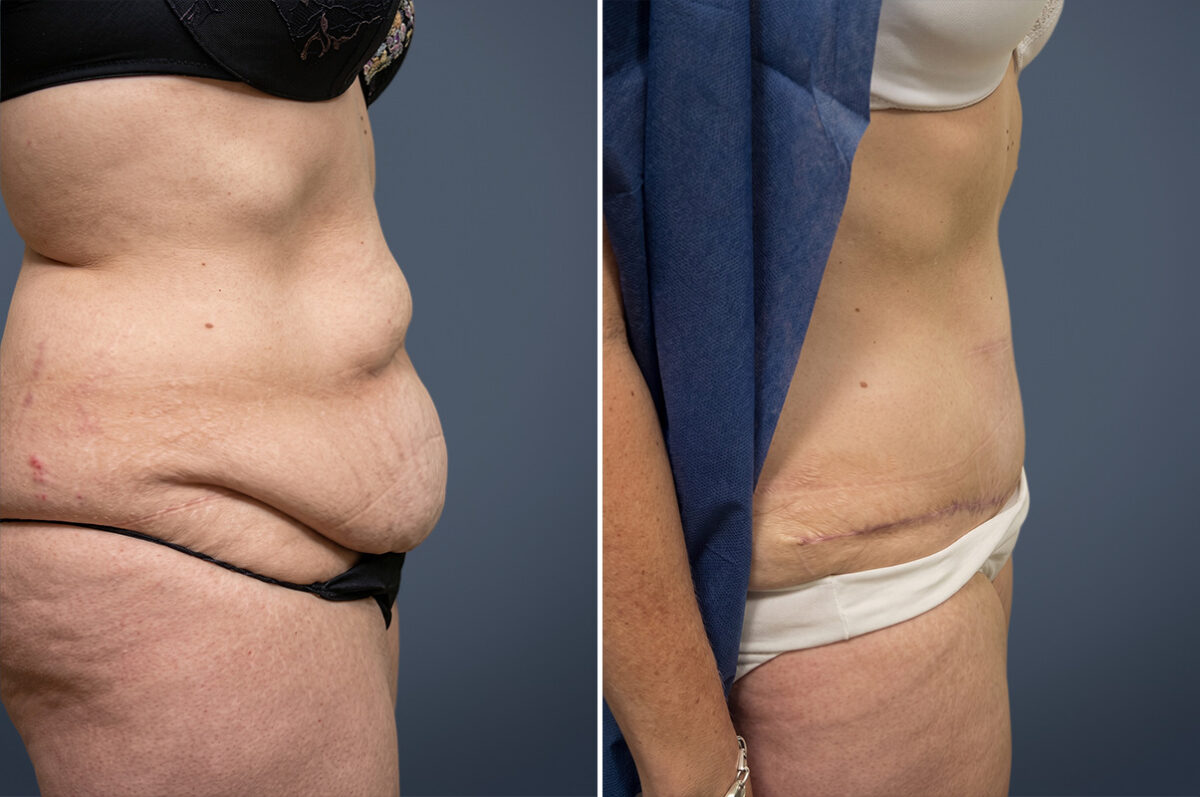 Tummy Tuck Before and After Photos in Princeton, NJ, Patient 23254