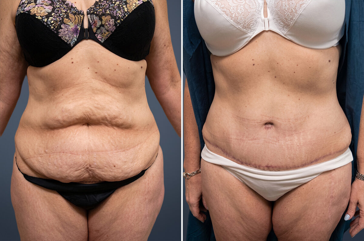Tummy Tuck Before and After Photos in Princeton, NJ, Patient 23254
