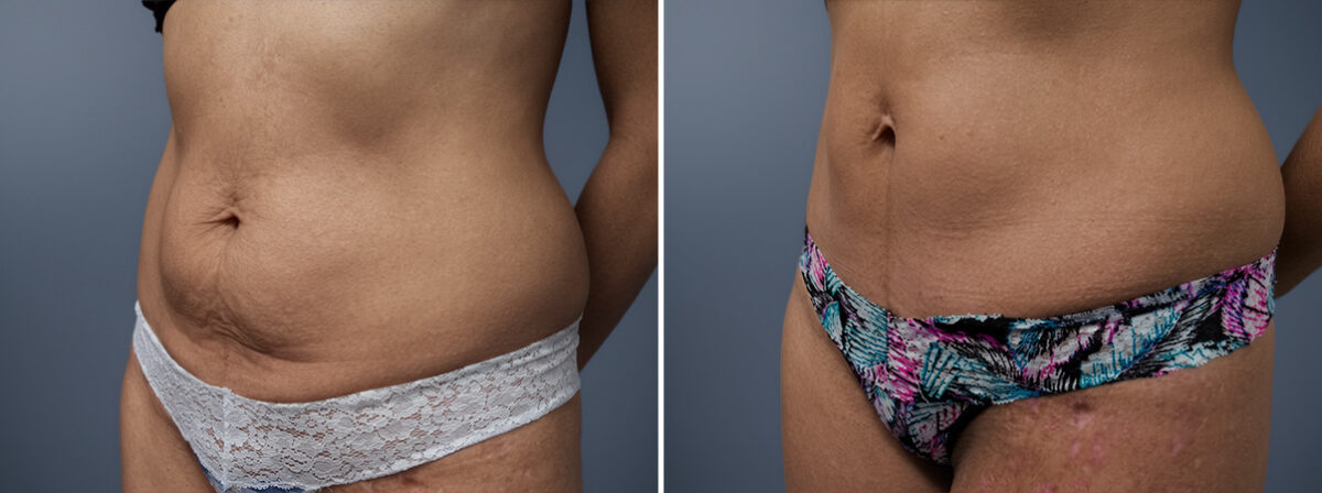 Mini Tummy Tuck Before and After Photos in Princeton, NJ, Patient 23268