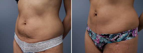 Mini Tummy Tuck Before and After Photos in Princeton, NJ, Patient 23268