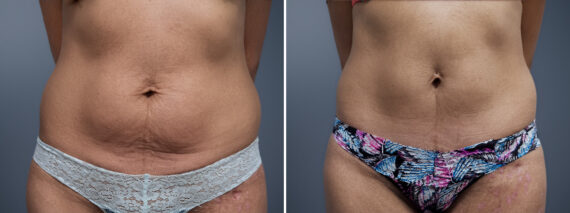 Mini Tummy Tuck Before and After Photos in Princeton, NJ, Patient 23268