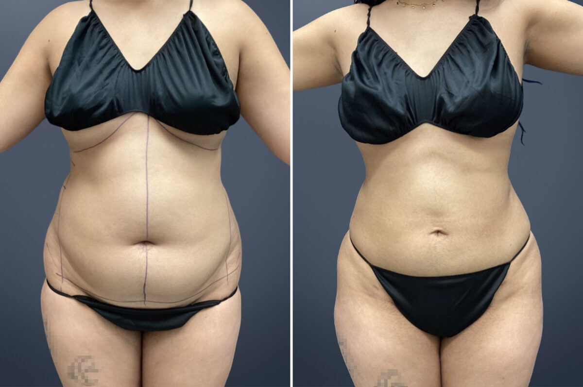 Mini Tummy Tuck Before and After Photos in Princeton, NJ, Patient 23275