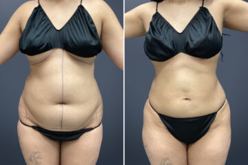 Mini Tummy Tuck Before and After Photos in Princeton, NJ, Patient 23275