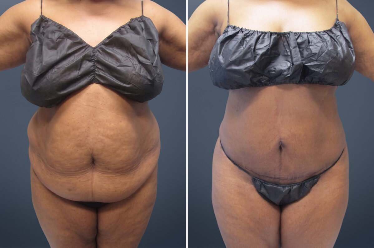 Mini Tummy Tuck Before and After Photos in Princeton, NJ, Patient 23279