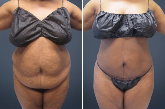 Mini Tummy Tuck Before and After Photos in Princeton, NJ, Patient 23279