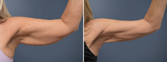 Arm Liposuction Before and After Photos in Princeton, NJ, Patient 23284