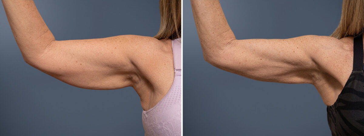 Arm Liposuction Before and After Photos in Princeton, NJ, Patient 23284