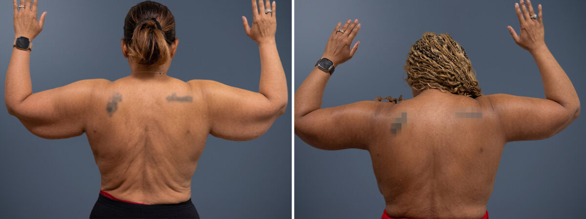 Arm Liposuction Before and After Photos in Princeton, NJ, Patient 23291