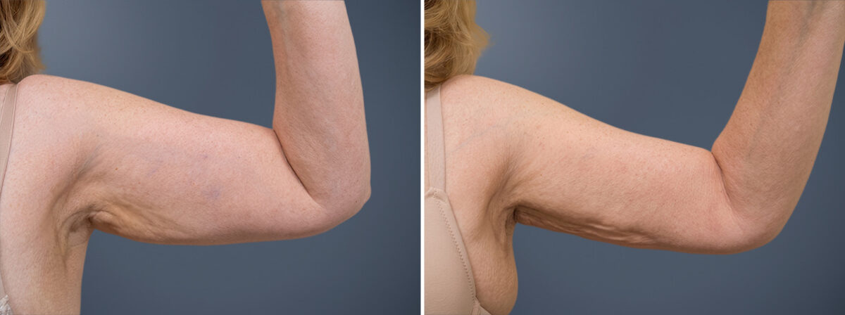 Arm Liposuction Before and After Photos in Princeton, NJ, Patient 23295