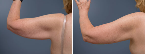 Arm Liposuction Before and After Photos in Princeton, NJ, Patient 23295