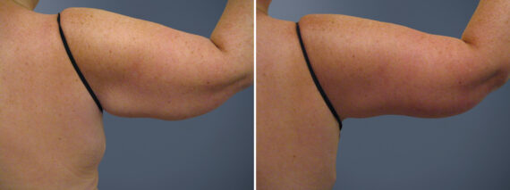 Arm Liposuction Before and After Photos in Princeton, NJ, Patient 23302