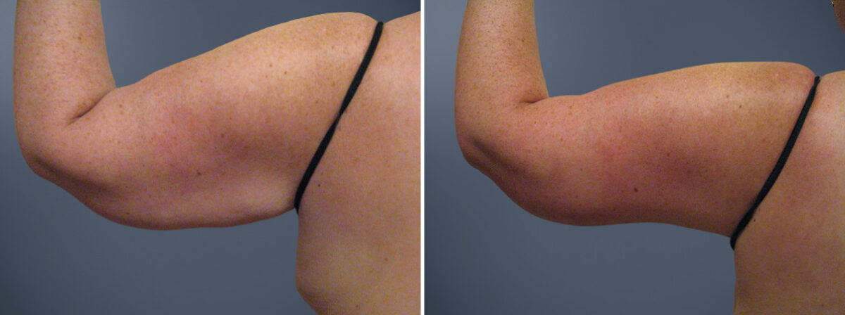 Arm Liposuction Before and After Photos in Princeton, NJ, Patient 23302