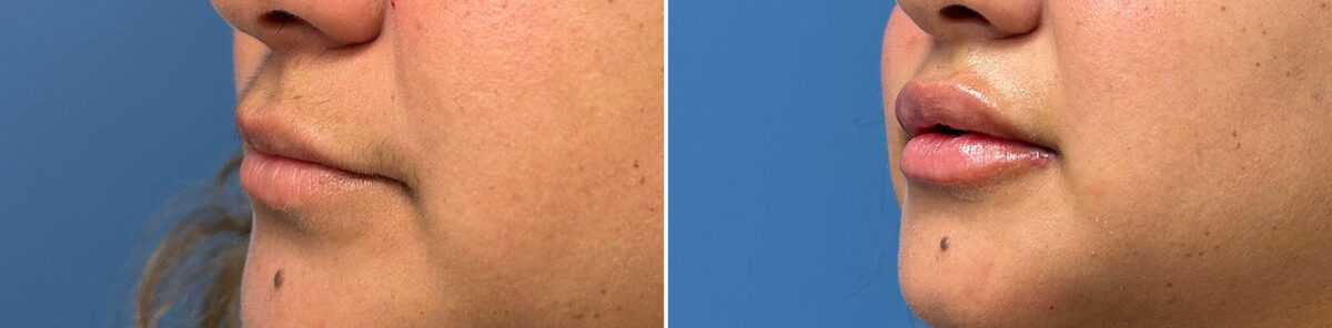 Injectable Fillers Before and After Photos in Philadelphia, PA, Patient 5197