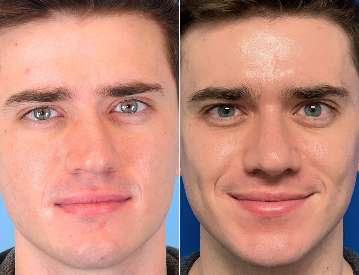 Rhinoplasty Before and After Photos in Sewell, NJ, Patient 1611