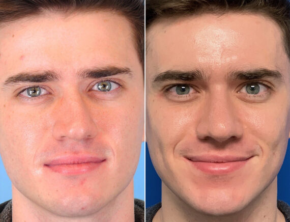 Rhinoplasty Before and After Photos in Sewell, NJ, Patient 1611