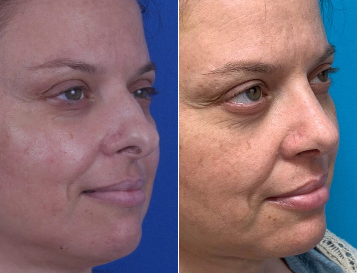 Bulbous Tip Before and After Photos in Sewell, NJ, Patient 1688