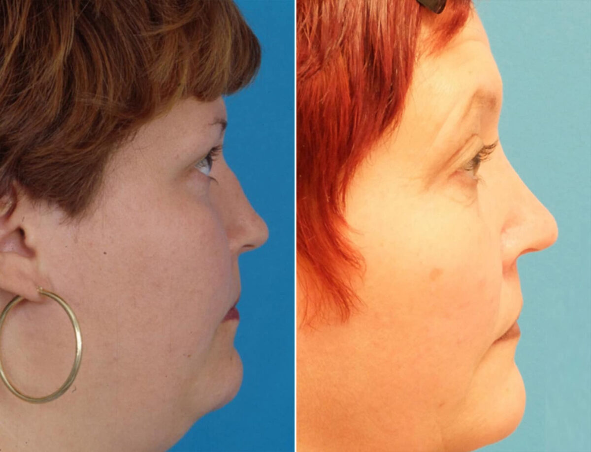 Nasal Bump Before and After Photos in Sewell, NJ, Patient 1698