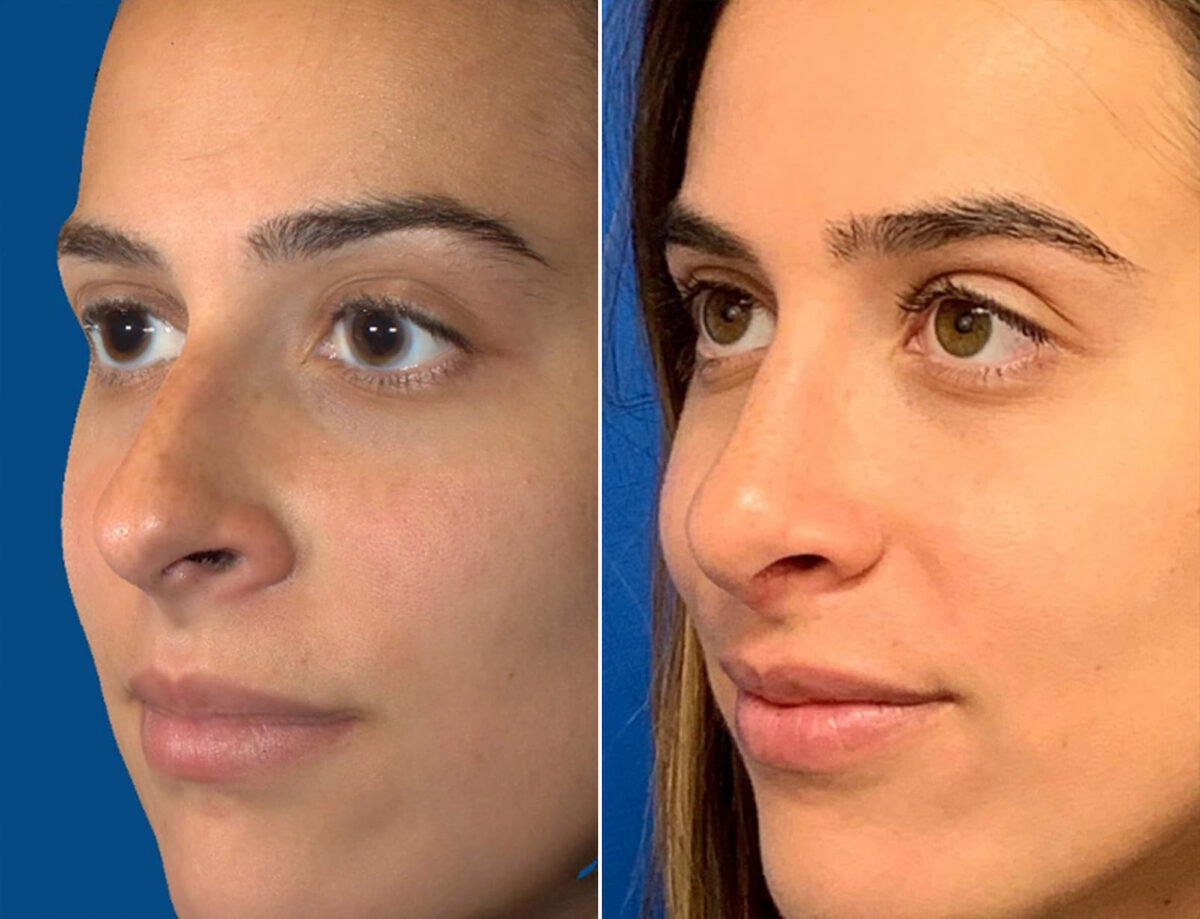Nasal Bump Before and After Photos in Sewell, NJ, Patient 1718
