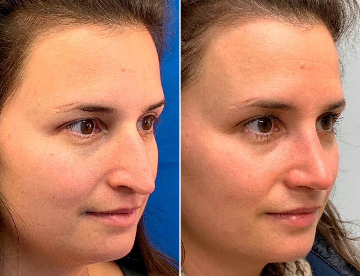 Droopy Nose Before and After Photos in Sewell, NJ, Patient 1750