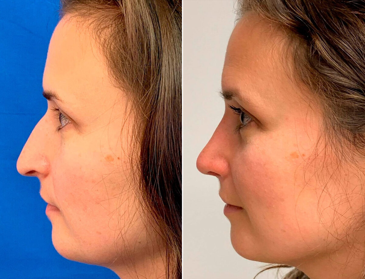Droopy Nose Before and After Photos in Sewell, NJ, Patient 1750