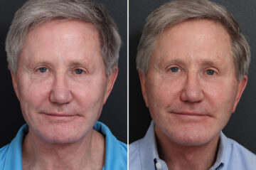 Chin Implants Before and After Photos in Princeton, NJ, Patient 21734