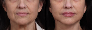 Deep Plane Facelift Before and After Photos in Princeton, NJ, Patient 21778
