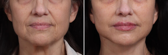 Deep Plane Facelift Before and After Photos in Princeton, NJ, Patient 21778