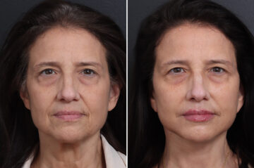 Deep Plane Facelift Before and After Photos in Princeton, NJ, Patient 21778