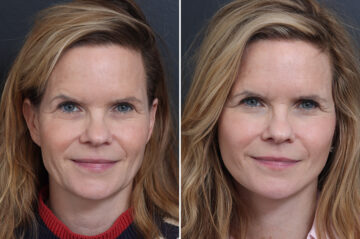 Facelift Before and After Photos in Princeton, NJ, Patient 22818